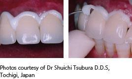 AL FAYROUZ MEDICAL EQUIPMENTS TRADING Glass ionomer luting cement -Riva Luting Glass ionomer luting cement