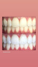 AL FAYROUZ MEDICAL EQUIPMENTS TRADING Teeth whitening - Pola office plus+ Teeth whitening